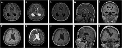 Individual Treatment Decisions for Central Neurocytoma